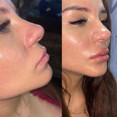 Antes y después de Aumento de labios 