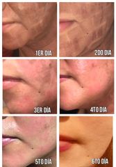 Antes y después de Peeling