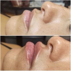 Antes y después de Aumento de labios