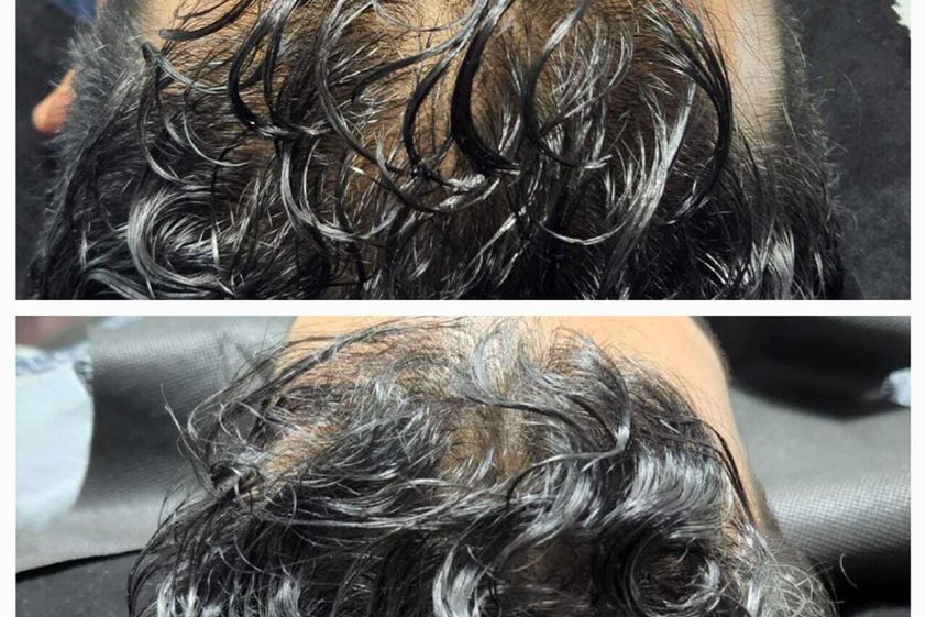 Plasma Rico en Plaquetas antes y después - 873924
