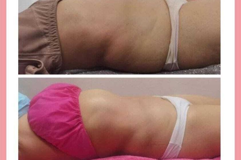 Eliminar grasa localizada antes y después - 874642