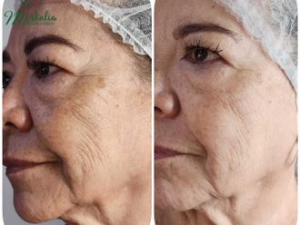 Tratamientos faciales antes y después - 874643
