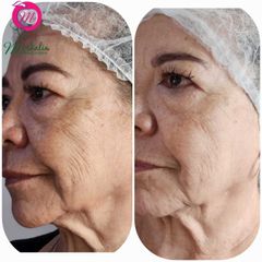 Tratamiento Facial - Moskalia
