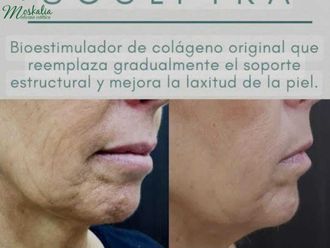 Rejuvenecimiento facial antes y después - 874648