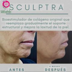 Sculptra Bioestimulador de colágeno - Moskalia