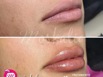 Aumento de labios antes y después - 874650