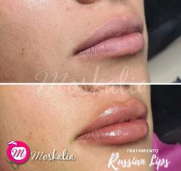 Tratamiento Russian Lips - Moskalia