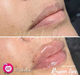 Tratamiento Russian Lips - Moskalia