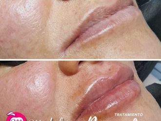 Aumento de labios antes y después - 874652