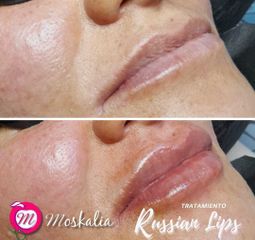 Tratamiento Russian Lips - Moskalia