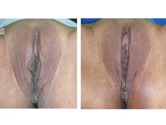 Rejuvenecimiento Vaginal antes y después - 499305