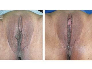 Antes y después de Rejuvenecimiento vaginal