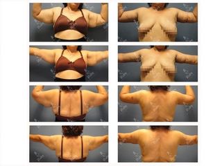 Antes y después de Braquioplastia