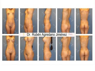 Antes y después de Mommy Makeover