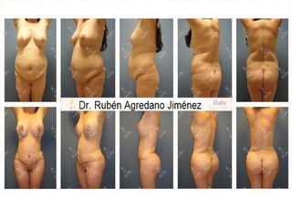 Antes y después de Mommy Makeover