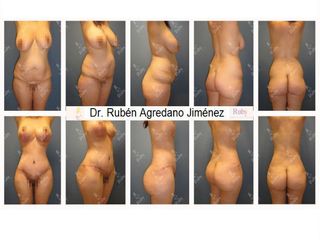 Antes y después de Mommy Makeover