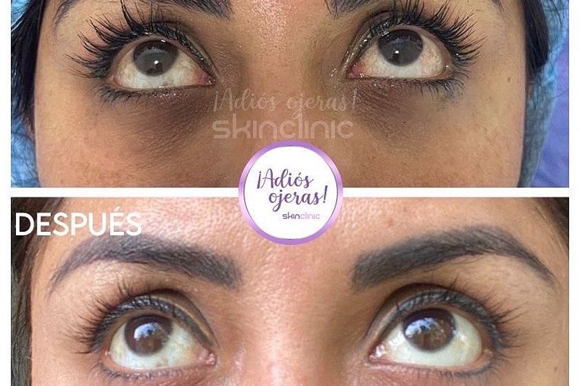 Tratamientos faciales antes y después - 811552