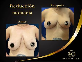 Reducción mamas - Dr. Franco Cravioto