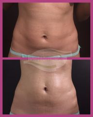 Antes y después de Lipoescultura