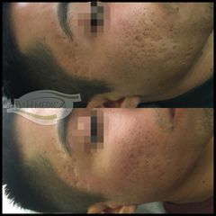 Antes y después de Láser CO2 Fraccionado