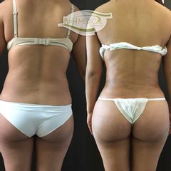 Antes y después de Liposucción