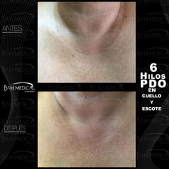 Antes y después de Hilos tensores en el cuello
