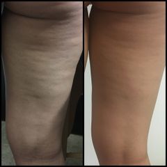 Antes y después de Tratamientos anticelulíticos