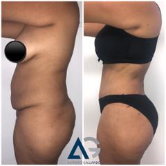 Antes y después de Abdominoplastia
