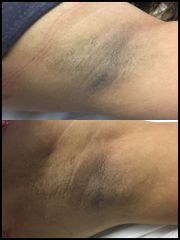 Antes y después de Manchas en la piel 
