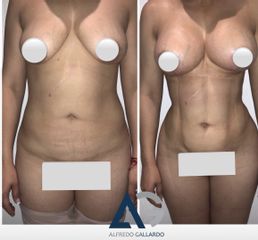 Antes y después de Liposucción