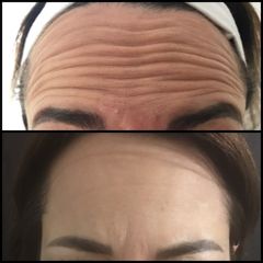 Antes y después de toxina botulínica 