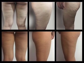 Carboxiterapia antes y después - 685080