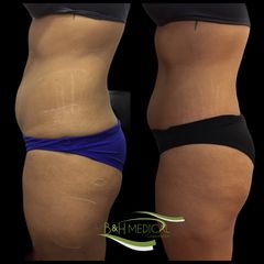 Antes y después de Liposucción 