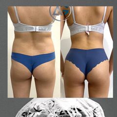 Antes y después de Liposucción 