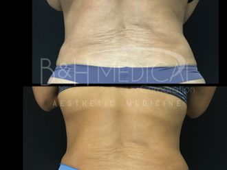 Lipólisis antes y después - 826372