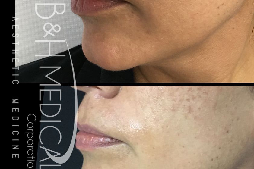 Rejuvenecimiento facial antes y después - 826433