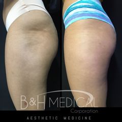 Radiofrecuencia - B&H Medical Corporation