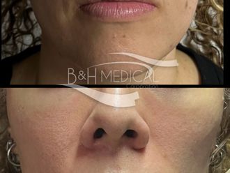 Rejuvenecimiento facial antes y después - 872553