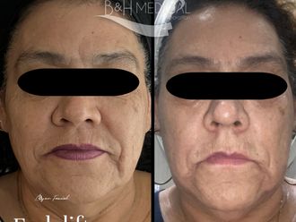 Rejuvenecimiento facial antes y después - 872554