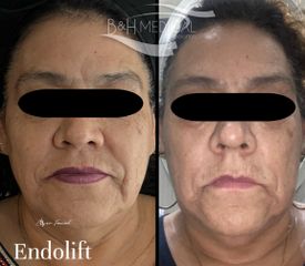 Lifting Facial sin cirugia - B&H Medical Corporation