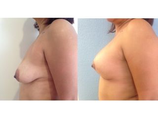 Antes y después de Mastopexia