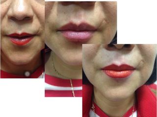 Antes y después de relleno labios