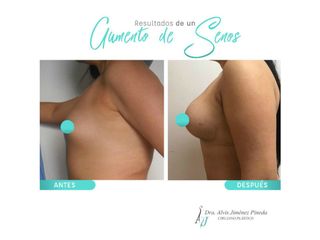 Antes y después de Aumento de busto