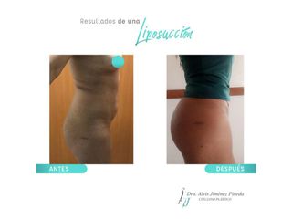 Antes y después de Liposucción