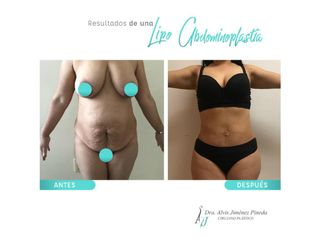 Antes y después de Lipo Abdominoplastia
