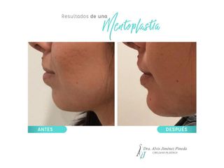 Antes y después de Mentoplastia