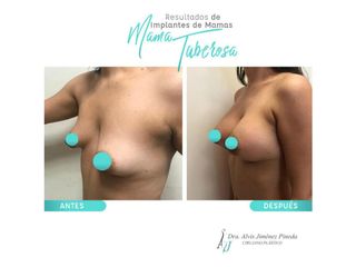 Antes y después de Aumento de busto