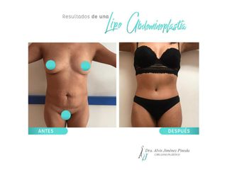 Antes y después de Lipoabdominoplastia