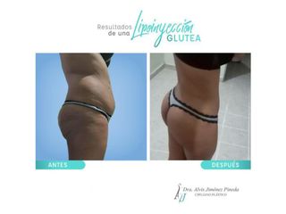 Antes y después de Lipoinyección Glutea