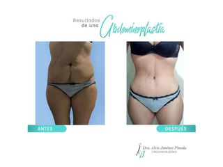 Antes y después de Abdominoplastia